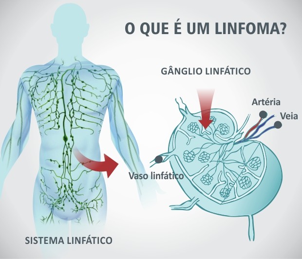 Dia Mundial de Conscientização sobre Linfomas (WLAD). linfoma é o câncer que afeta os linfócitos, células responsáveis por proteger o corpo de infecções.